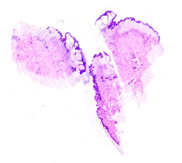 Slide tissue biopsy from skin for diagnosis in pathology laboratory. Image Copyright: Pongsak A / Shutterstock